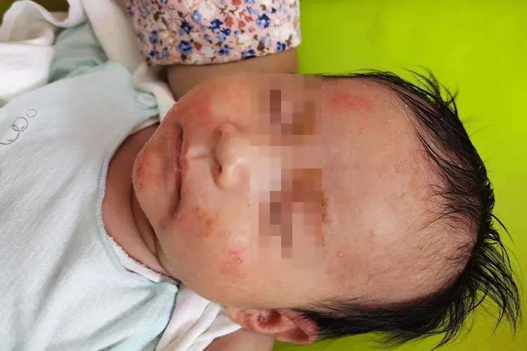 宝宝湿疹和痱子的区别图片