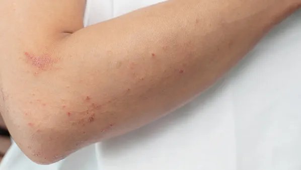 汗斑怎么治