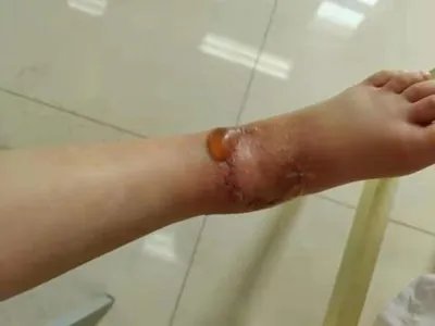 丹毒症状图片