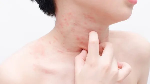 带状疱疹传染吗