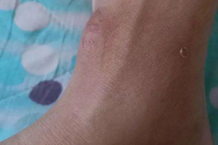 腱鞘囊肿图片
