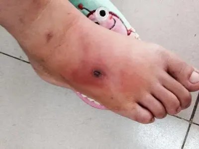 丹毒症状图片
