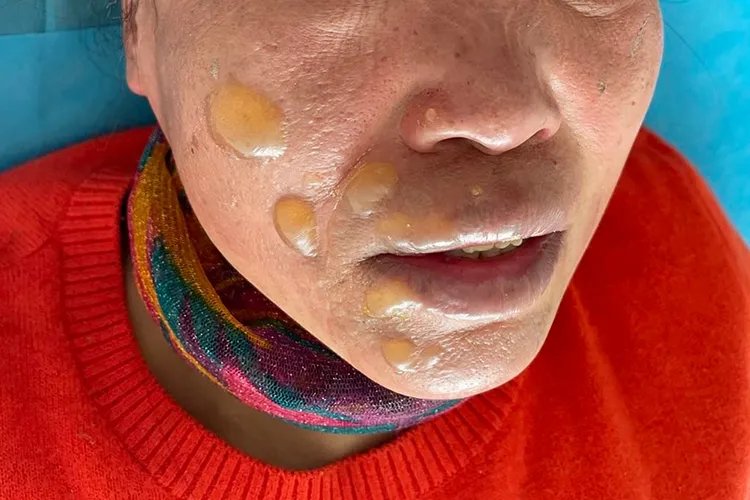 烧伤脸部图片