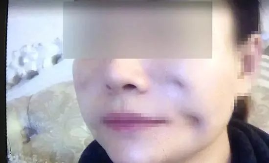 女子脸部整容整出八个坑整形机构人员怎么说?