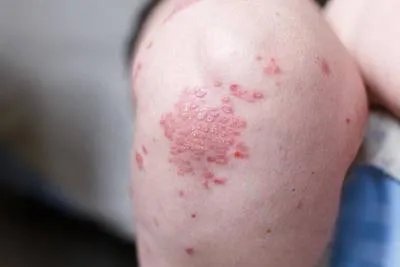 丘疹型荨麻疹怎么消除