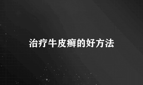 治疗牛皮癣的好方法