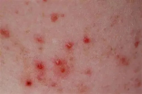 皮脂腺毛囊炎图片