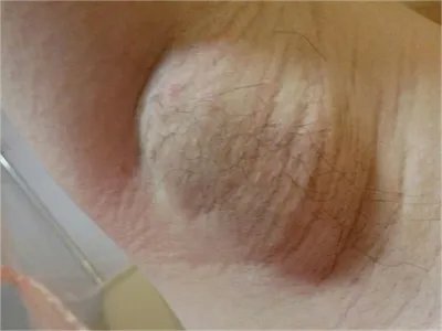 乳腺癌肿图片