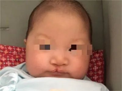 唇裂症状图片