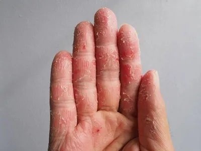 手部湿疹红斑图片