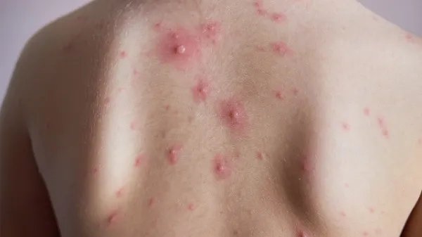 背上长痘痘什么原因导致的 背上长痘痘怎么快速去除