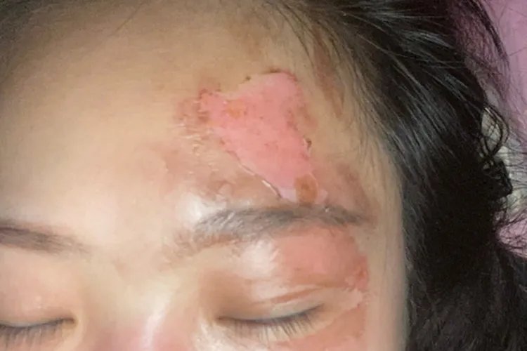 烧伤脸部图片