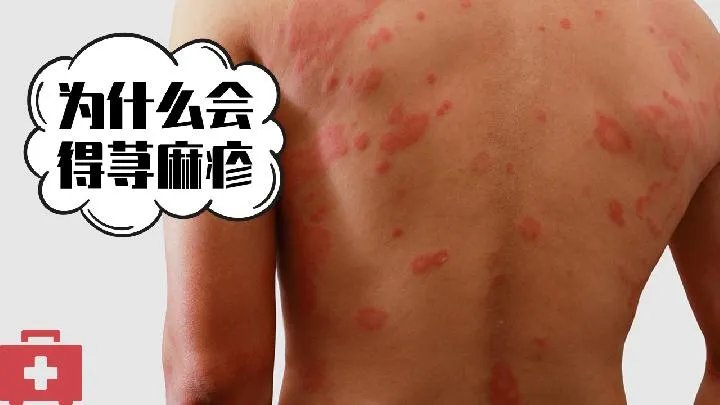 治荨麻疹的药物有哪些