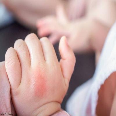 宝宝被蚊子咬了怎么办 4个快速消炎止痒介绍给宝妈