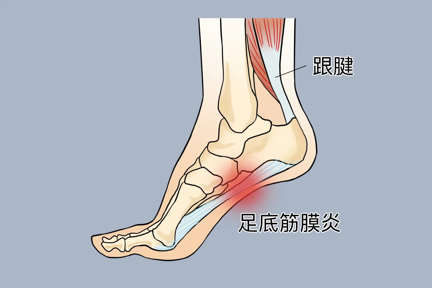 右脚足底疼痛位置图