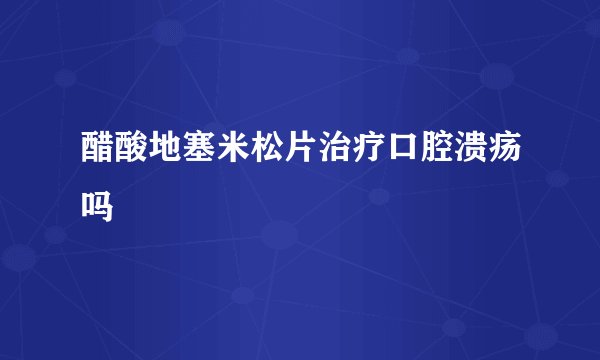 醋酸地塞米松片治疗口腔溃疡吗