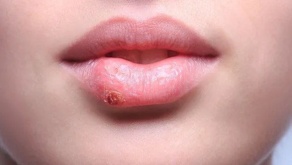 口角疱疹是怎么引起的