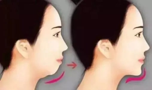 整容下巴大概多少钱