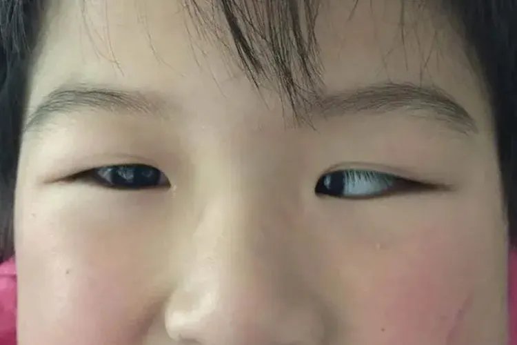 斗鸡眼照片