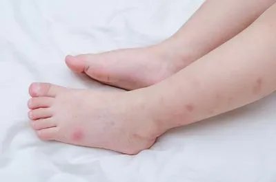 蚊虫叮咬用什么药膏 蚊虫叮咬用这些药膏可改善